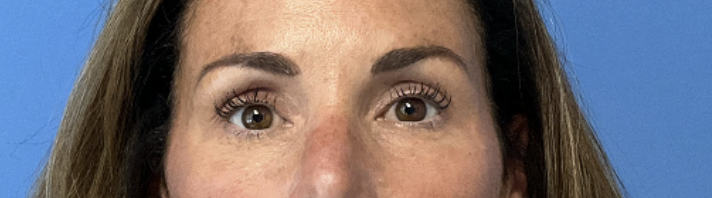 Blepharoplasty--Case-Study-3078 | After Blepharoplasty